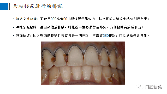 牙体预备时应该注意避免车针对游离龈内侧上皮的损伤和出血,以免边缘