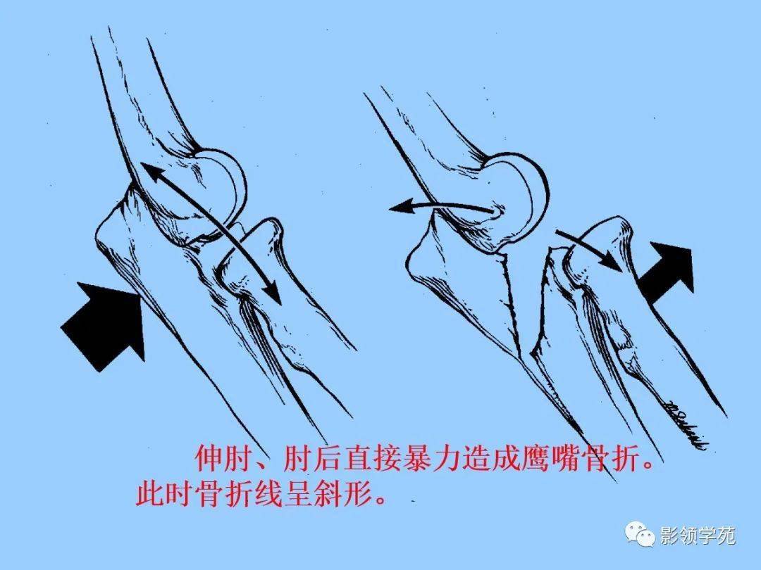 儿童骨折的类型及影像特点