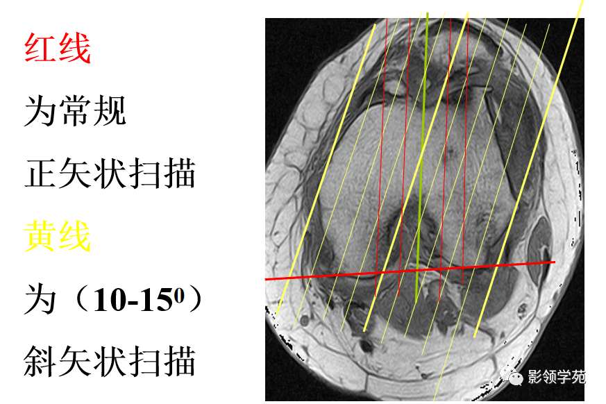 交叉韧带解剖及损伤的mri诊断