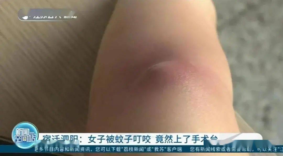 女子被蚊子叮一下竟要住院!还得动手术!