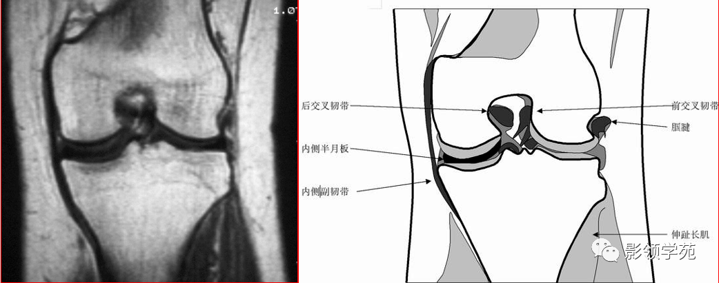 交叉韧带解剖及损伤的mri诊断