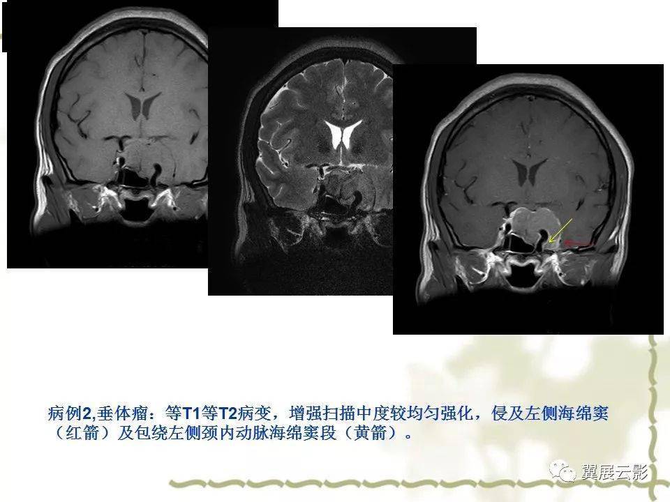 海绵窦解剖和12种常见疾病影像诊断