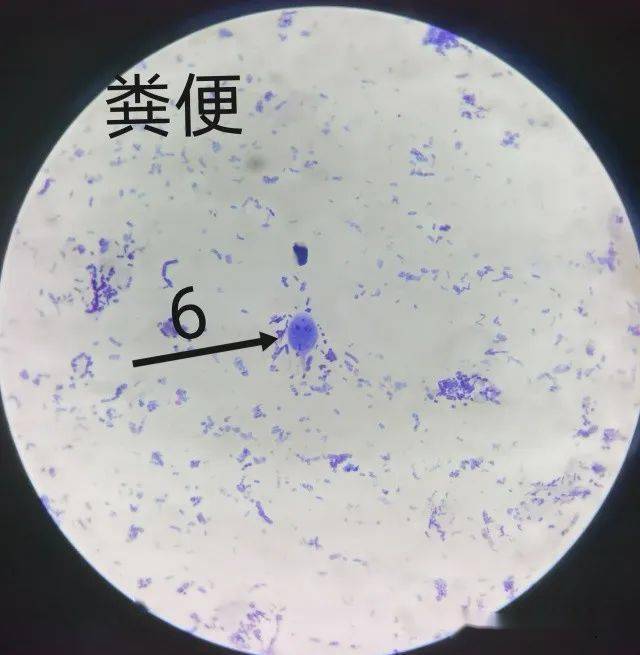 06 「蓝氏贾第鞭毛虫滋养体」 形态特征:呈倒置梨形,两侧对称,背面