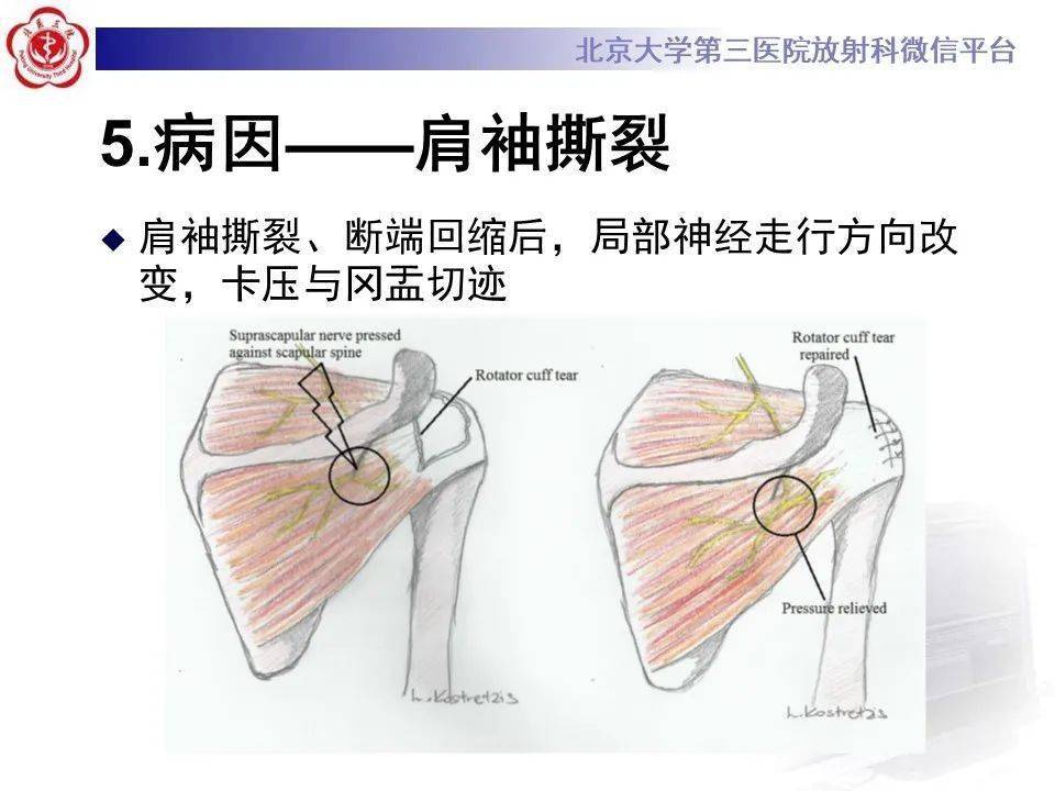 肩胛上神经卡压影像表现