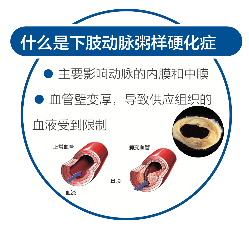 广安门|【广医时讯】广安门医院举办“周围血管疾病义诊宣传日”系列活动