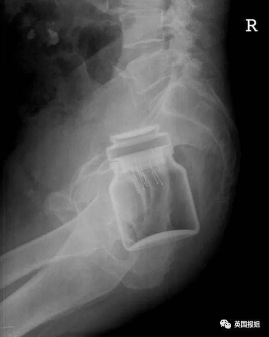 塞2斤金条藏8部手机…人类对肛门的探索太可怕了