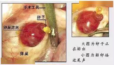 卵泡成熟后不破裂怎么办