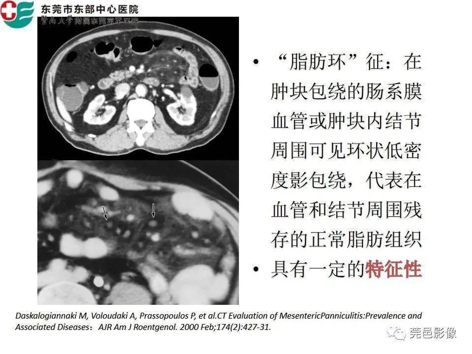 【每日一例1175】肠系膜脂膜炎的ct表现