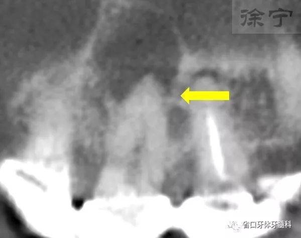 【病例分享】显微根管外科手术中根管侧支的诊断和处理