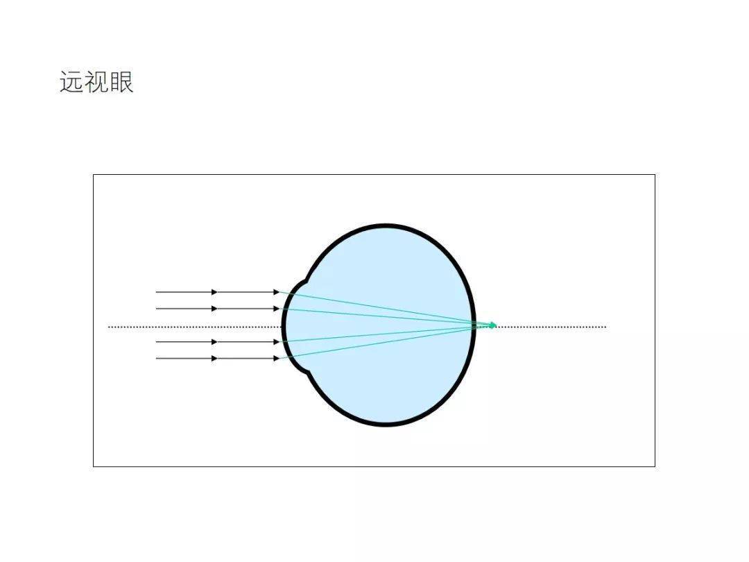 远视眼在视网膜后成像.