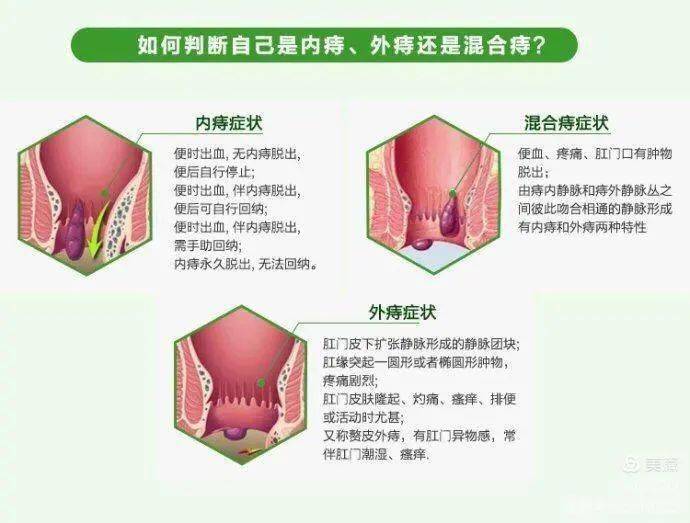 混合痔症状:便血,肿胀疼痛,脱垂.