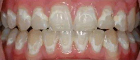 矫正牙齿会造成牙齿脱矿?为什么?