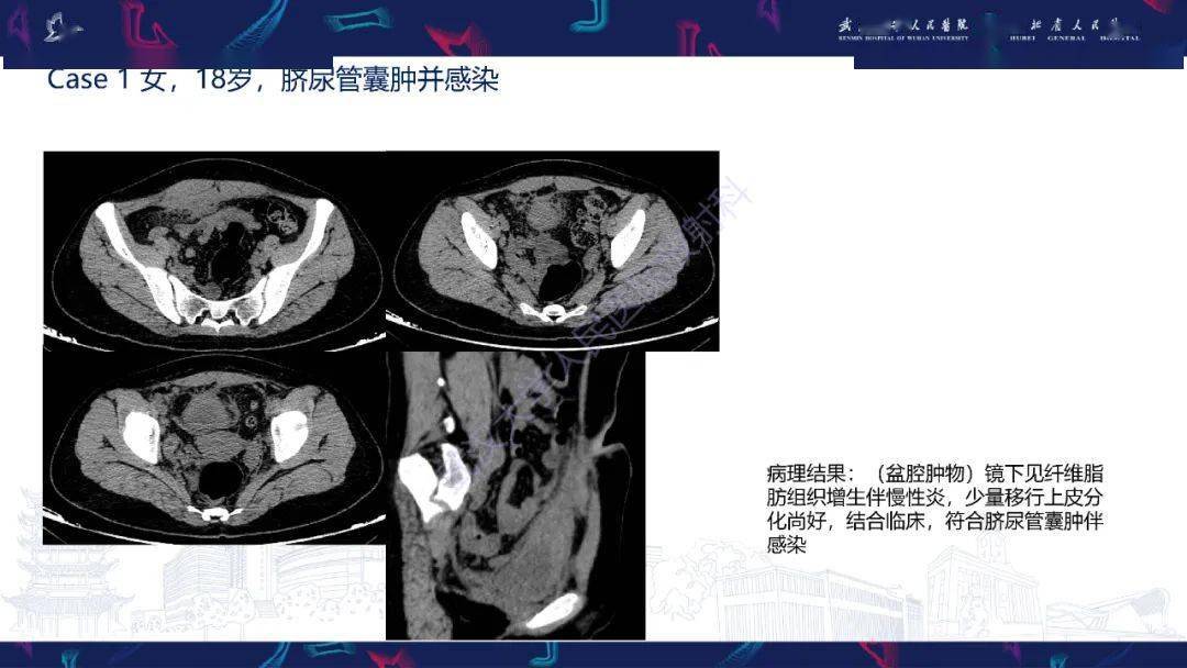 脐尿管病变影像诊断