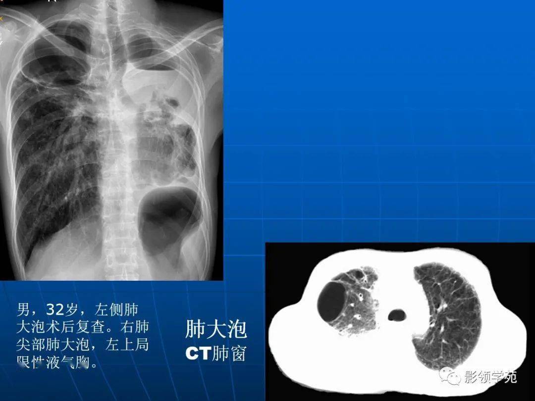 肺气肿的影像诊断