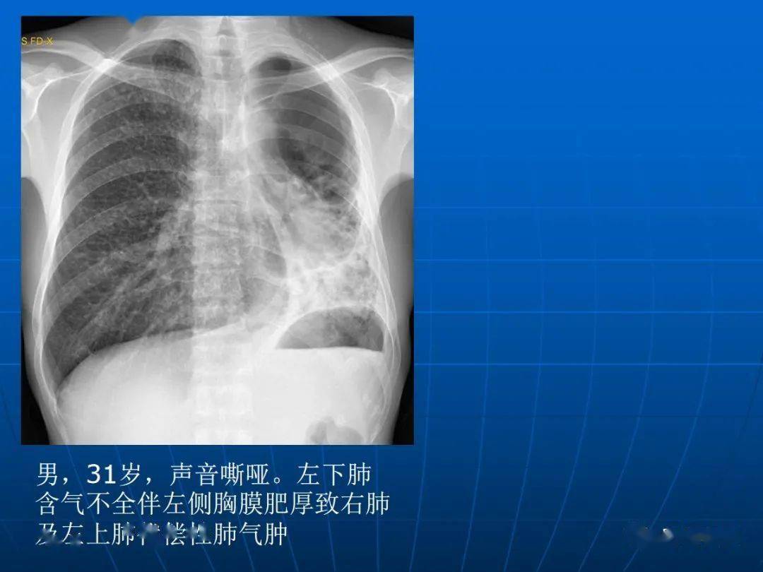 肺气肿的影像诊断