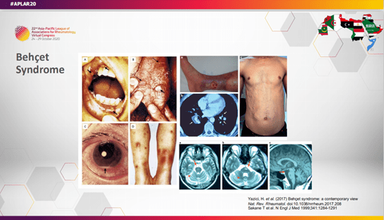 症状|反复口腔溃疡，白塞病最新进展一文掌握！| APLAR 2020