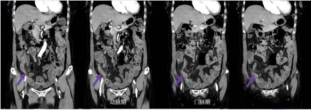 片上|CT 片上总是找不到阑尾？3 步法教你快速定位