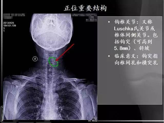 详细颈椎x线解读及关于颈椎病的影像学诊断及分型汇总