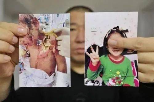 辽宁6岁女童疑遭生母与男友虐待,医生在女童腿上取出钢针