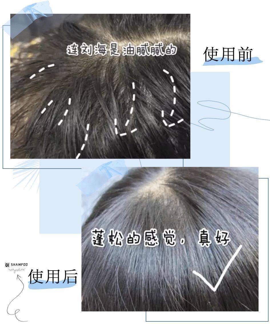 克兰|头上抠下的“白泥”，居然不是头皮屑？脱发头油都是因为它？