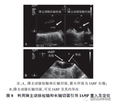 心动图|经食管超声心动图在非心脏手术中应用专家共识 （2020版）