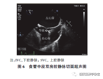 心动图|经食管超声心动图在非心脏手术中应用专家共识 （2020版）