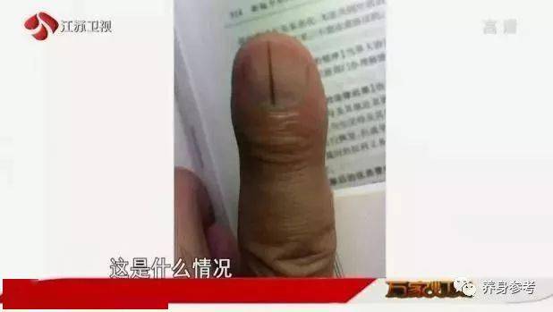 指甲长成这样,竟是癌症的信号?发生这些变化,不要忽视!