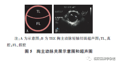 心动图|经食管超声心动图在非心脏手术中应用专家共识 （2020版）