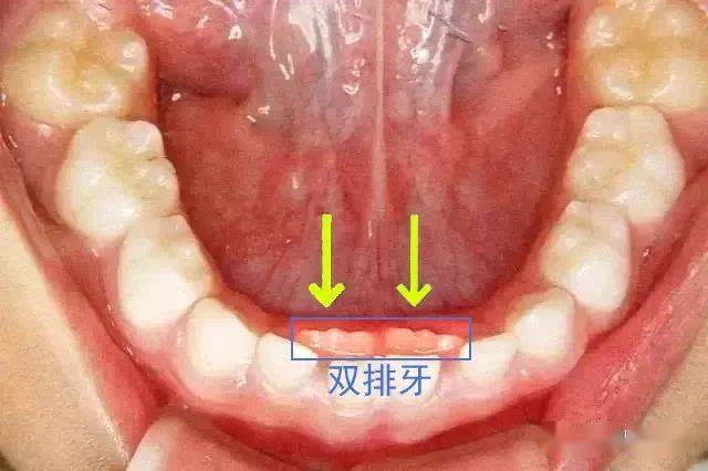 这个孩子竟然有"双排牙" ……_乳牙