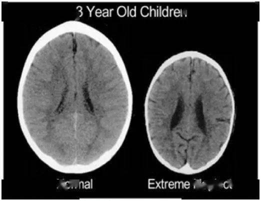 几个月胎儿大脑发育高峰期 df10a3145459441db110583f70a1e6ed.jpeg