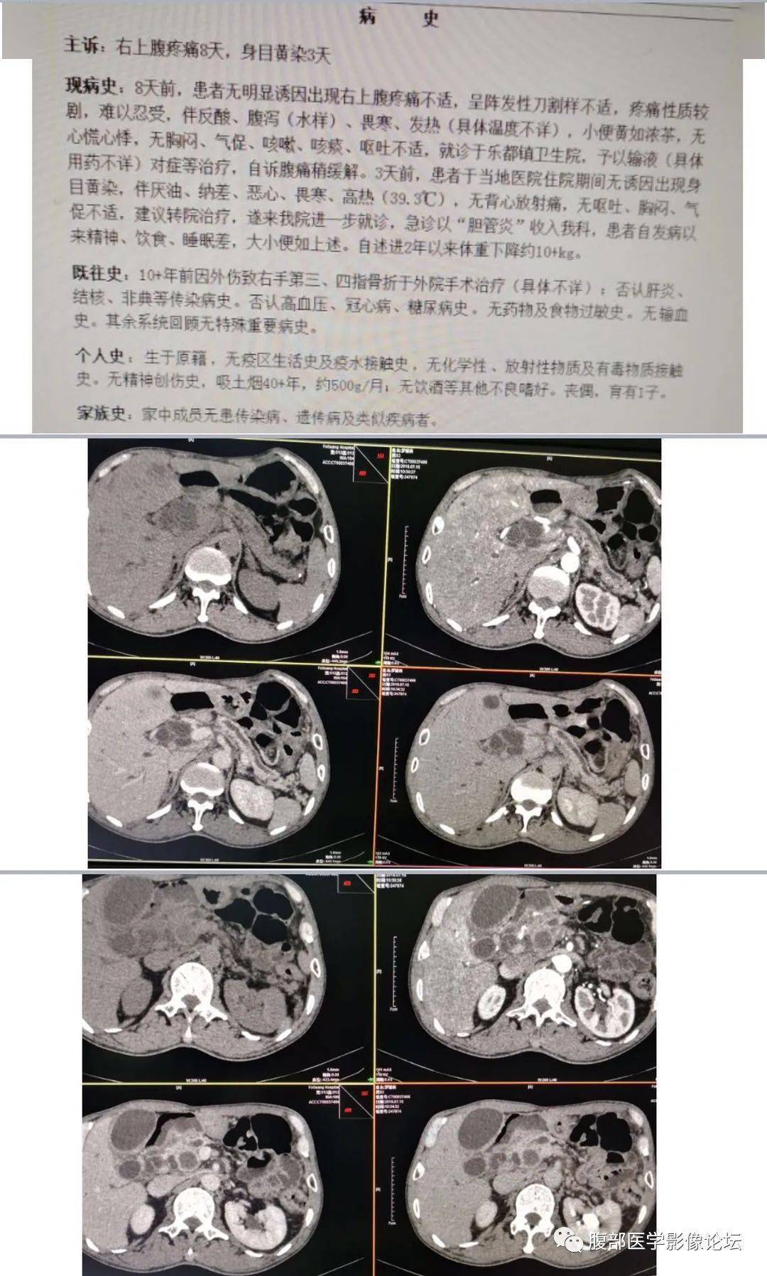 胰腺丨胰腺胶样癌伴ipmn_扩张