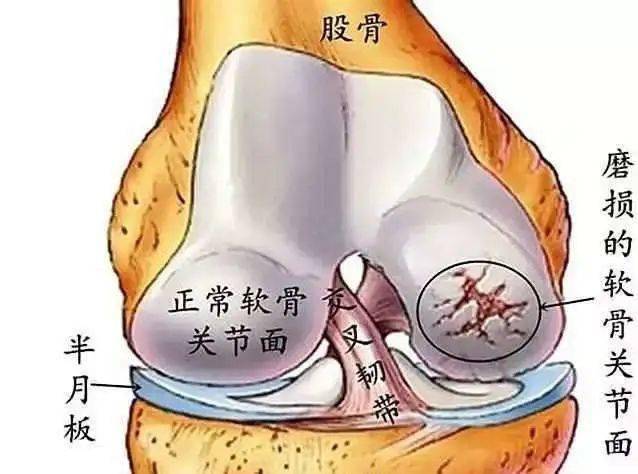 效果显著的艾灸治疗膝关节疼痛的方法