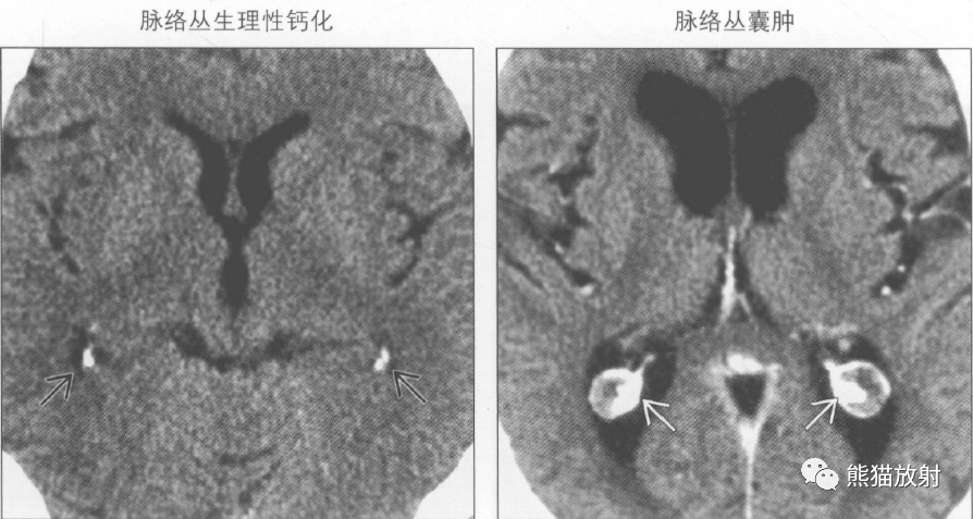 鉴别诊断—脑室内钙化