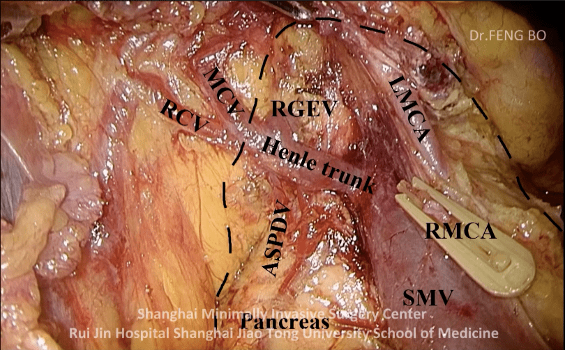 是  系膜间间隙 从 下往上由 trcs 拓展进入,从下往上解剖结肠中血管