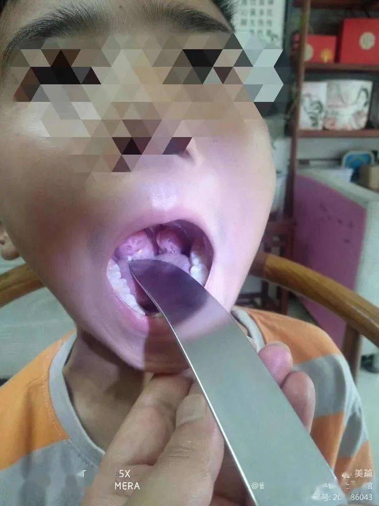 慢性扁桃体炎扁桃体肥大烙治疗法——赵江涛