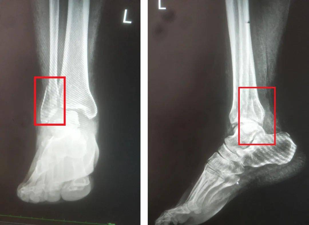 经x线检查,患者诊断为"左踝关节外踝骨折,左踝关节半脱位".
