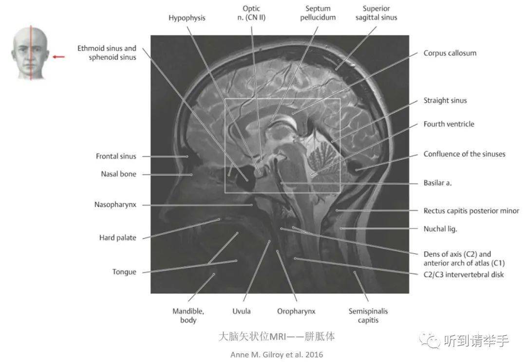 关于胼胝体发育不全