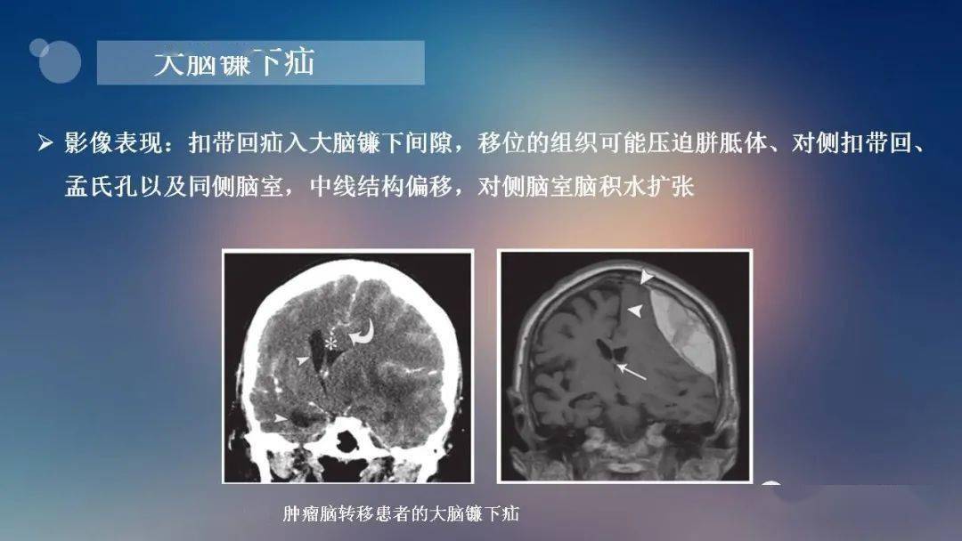 神经必备:脑疝的类型及其影像学特征