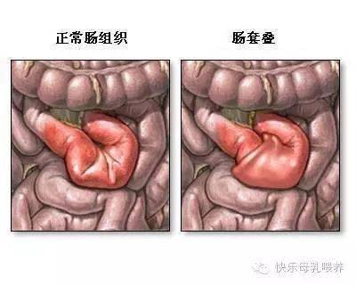 救命|爸妈必备救命常识 | 肠套叠黄金12小时