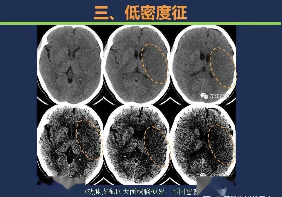 【影像】头颅ct如何预判超早期脑梗死?