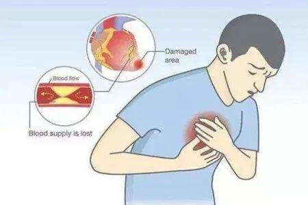 怎样才能有效防止心梗 a0215457bac24c37b9bfce0bc3690370.jpeg