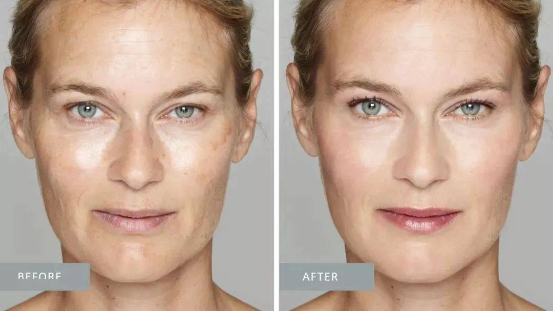 皮肤|一杯奶茶钱就能做的医美，做完立刻后悔！