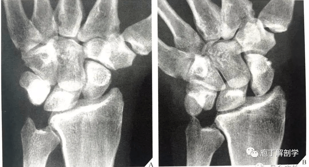 腕关节脱位及其x片阅读技巧