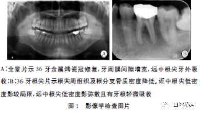 朗格汉斯细胞组织细胞增生症误诊分析1例