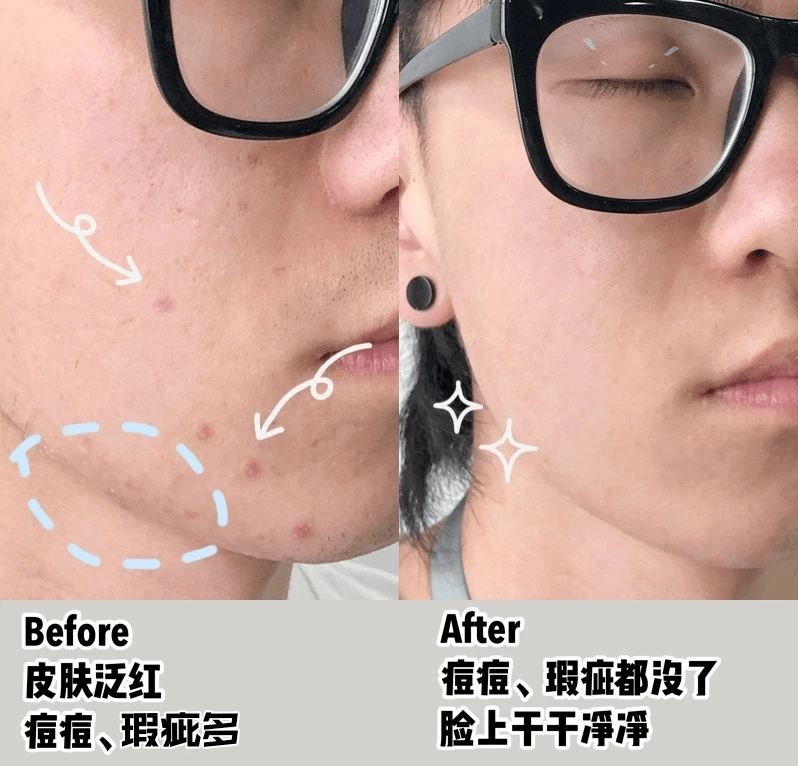 祛痘|长痘几天好不了？学会这招，没有1颗痘活过今晚！