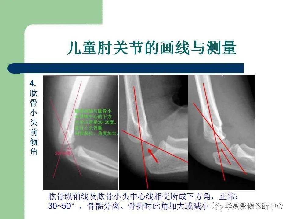 影像基础儿童肘关节损伤x线诊断