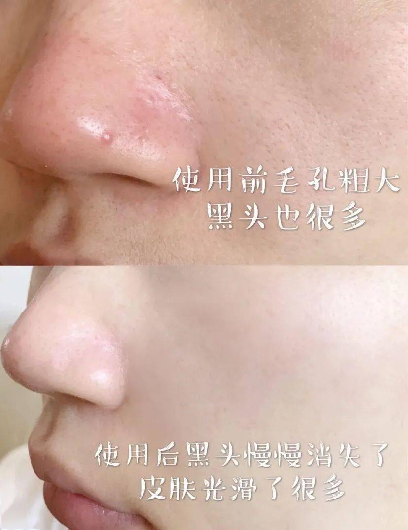 黑头|只要39元，轻松“磨皮”，让你的皮肤好到爆！