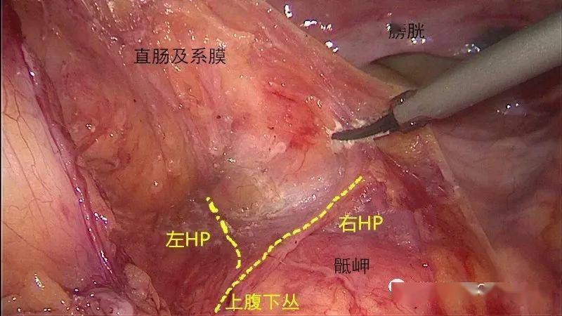 腔镜直肠手术找不到需要保护的神经这份图解你一定需要