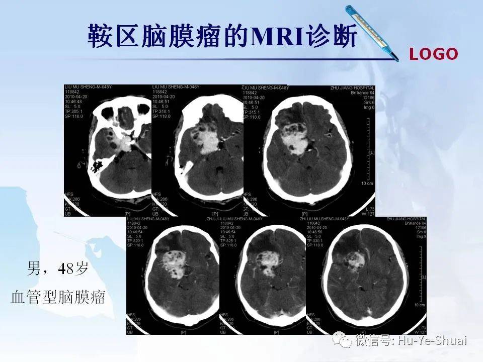 影像鞍区肿瘤的mri鉴别诊断