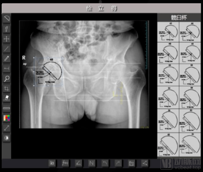 绘影|绘骨绘影：创新多功能术前设计产品，术前模板测量准确率达90%